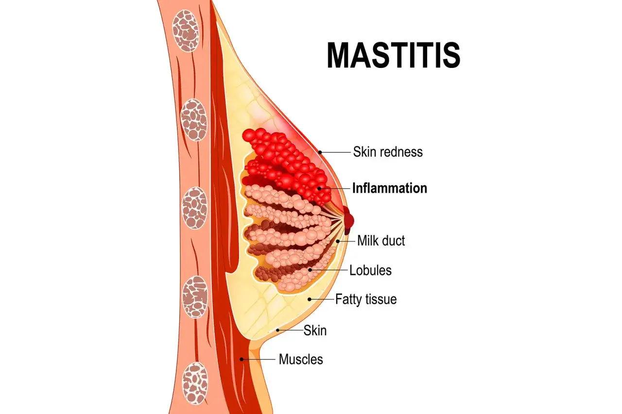 Illustration anatomique montrant les symptômes de la mastite : rougeur cutanée, inflammation des lobules et des canaux galactophores.