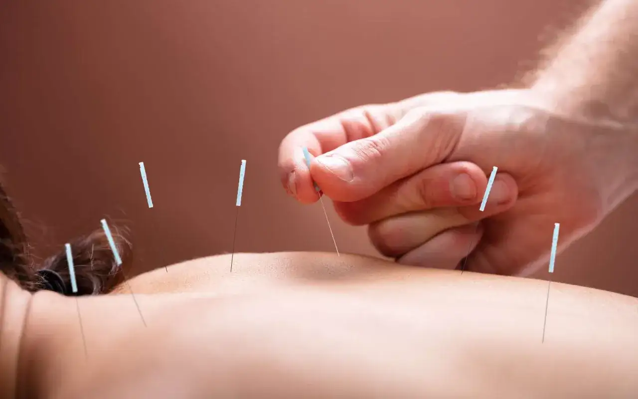 Acupuncture : effet au bout de combien de temps ? Des aiguilles fines sont ins&eacute;r&eacute;es dans le dos d'une personne.