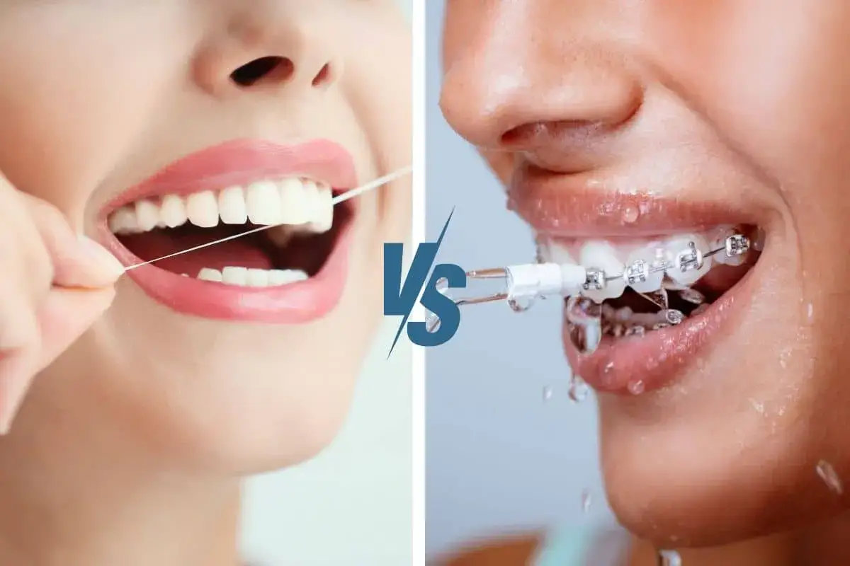 Porównanie: nitkowanie zębów efekty z nicią dentystyczną vs. irygatorem przy aparacie ortodontycznym.