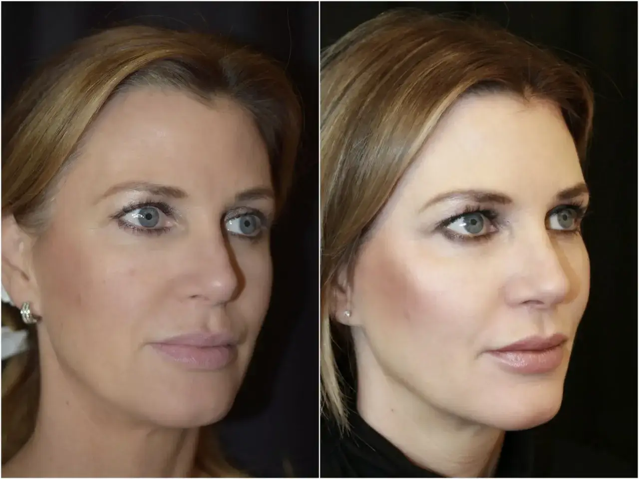 Före- och efterbilder visar en kvinna som fått botox eller fillers i pannan för ett slätare utseende.