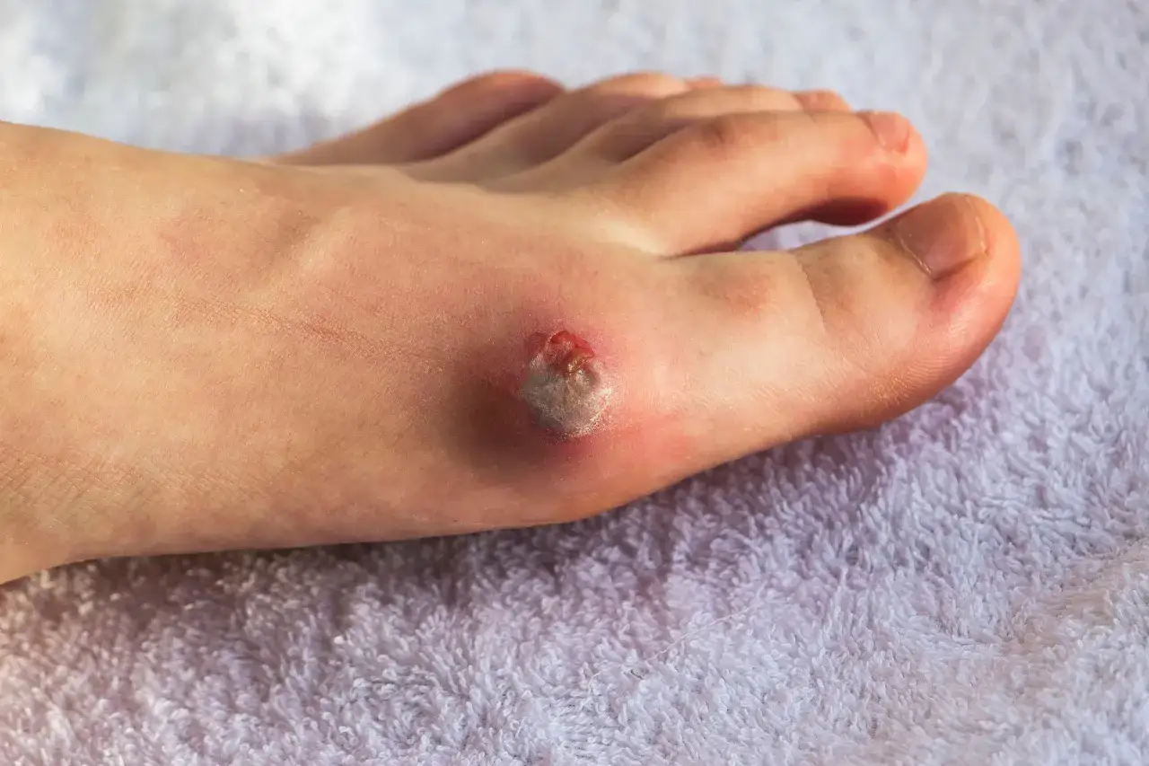 Stopa z raną, która może być objawem neuropatii cukrzycowej.
