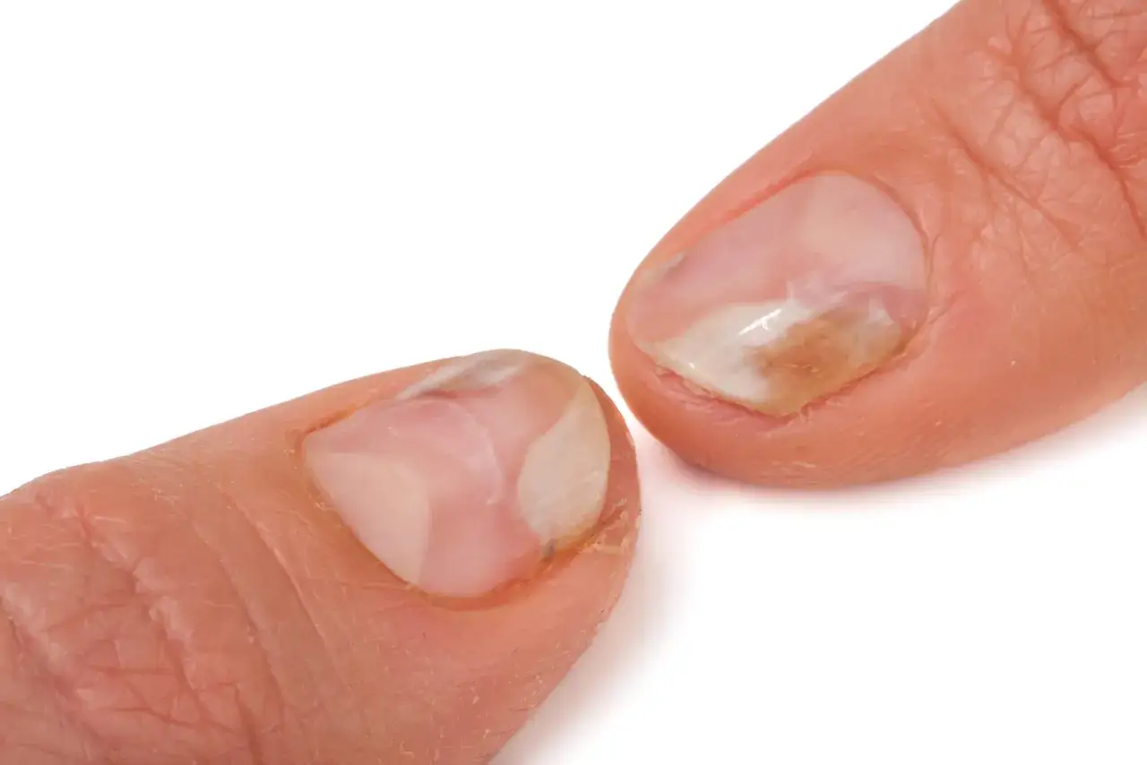 dermatolog bada paznokcie u rąk