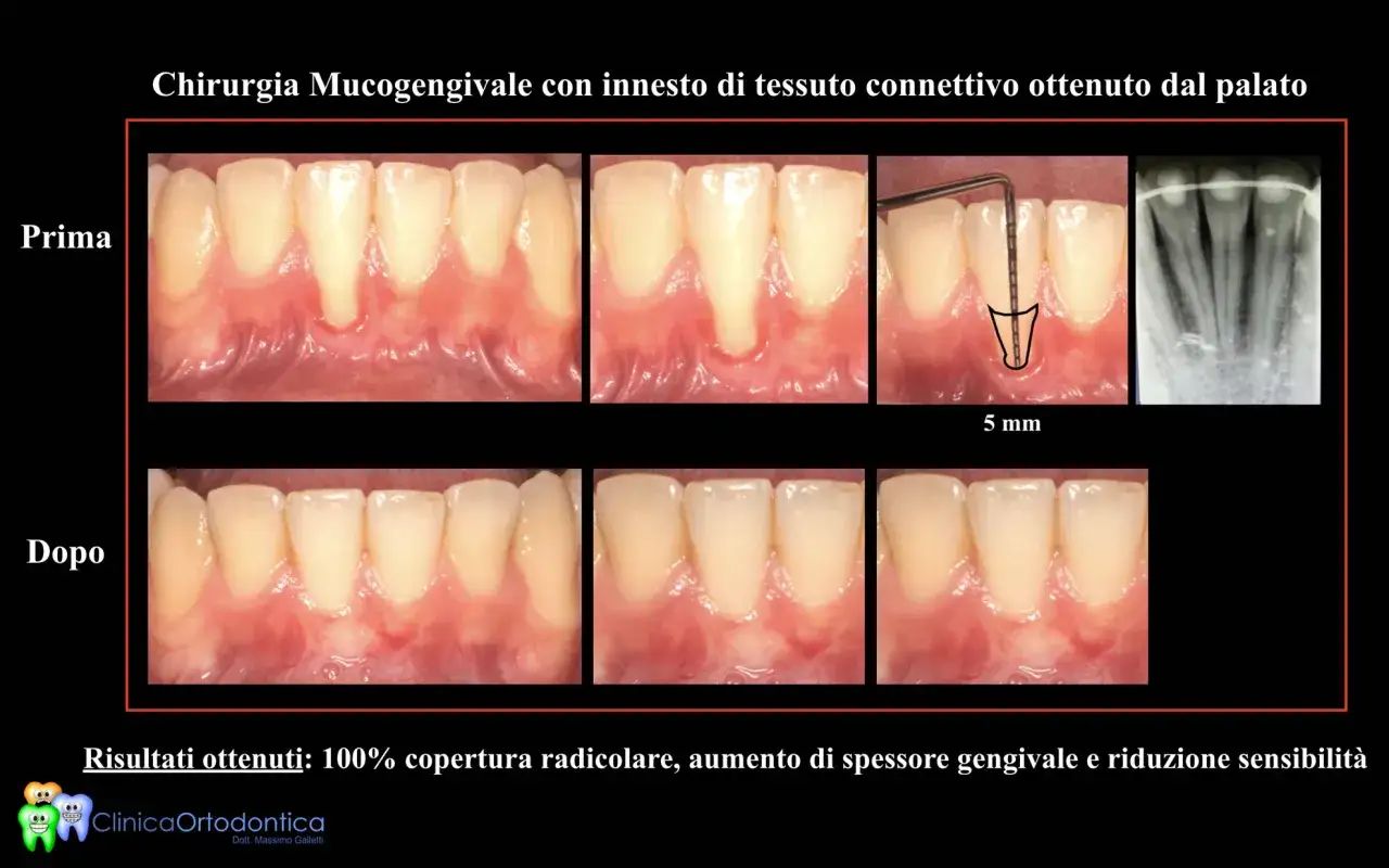 Prima e dopo un innesto gengivale per ricoprire la radice esposta, migliorando estetica e salute.