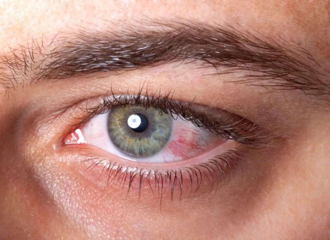 Czerwone, podrażnione oko z widocznymi naczynkami, objaw zespołu suchego oka.