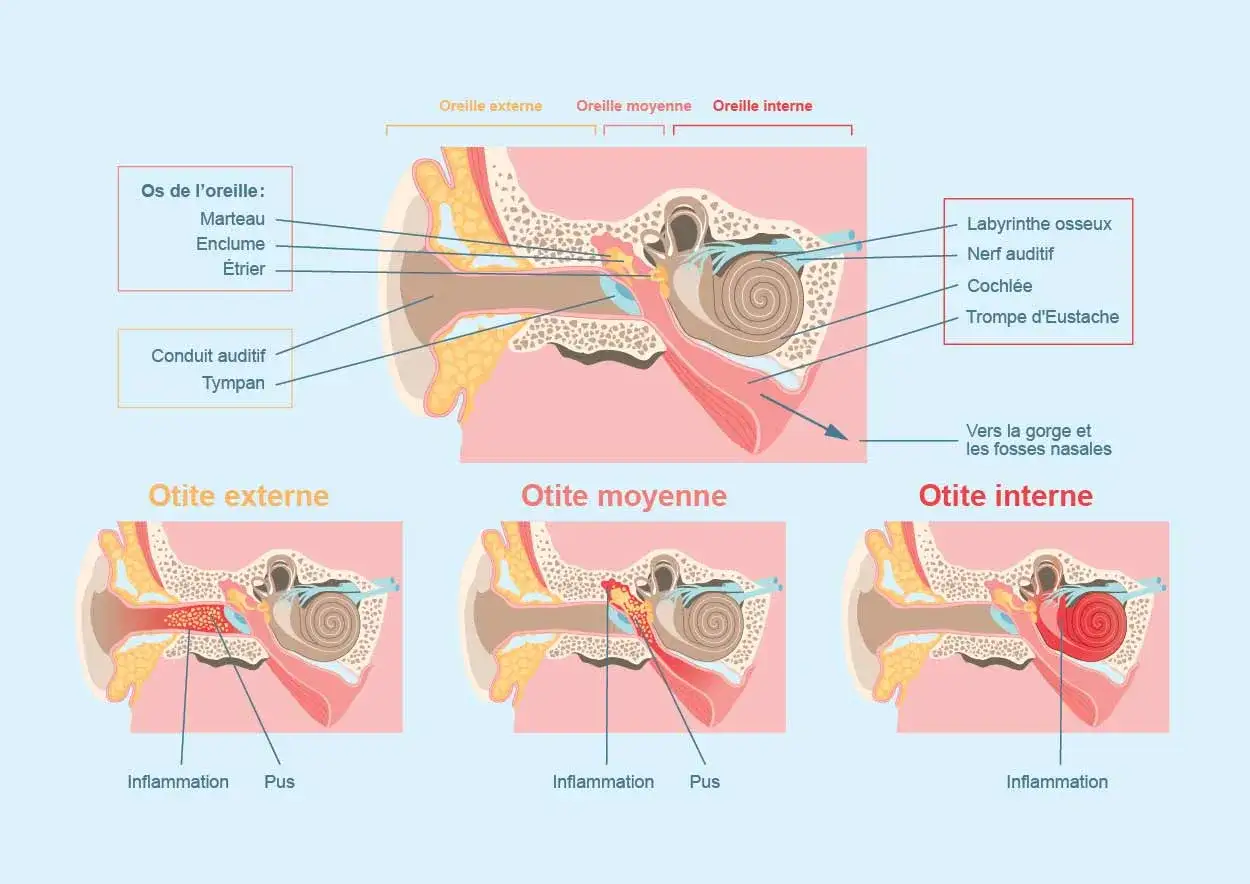 Schéma de l'oreille montrant les différentes parties et trois types d'infection : otite externe, moyenne et interne, avec inflammation et pus.