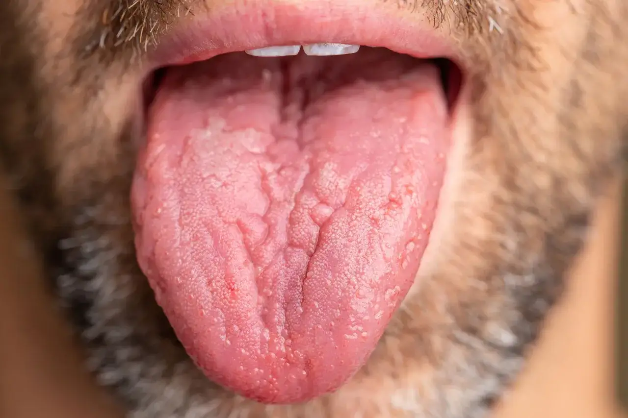 Lingua spaccata con papille evidenti e un aspetto ruvido, circondata da barba.
