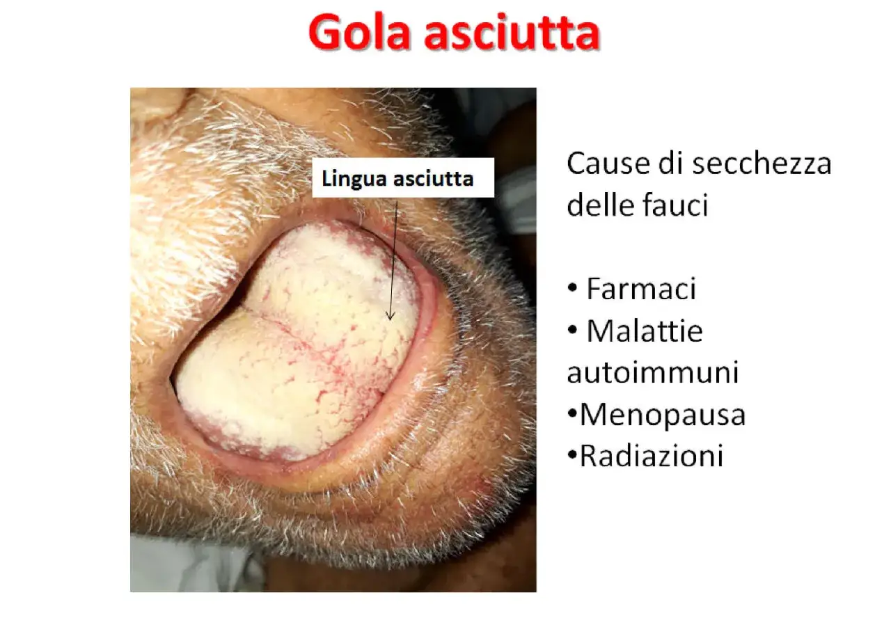 Lingua asciutta, con placche biancastre e arrossamenti, indica secchezza delle fauci. Cause: farmaci, malattie autoimmuni, menopausa, radiazioni.