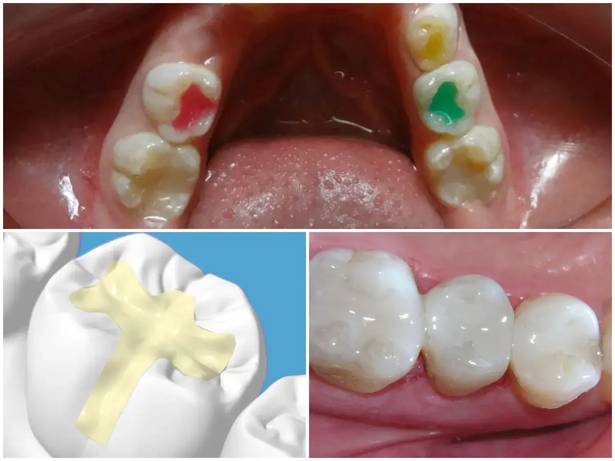Denti con colorazioni per la sigillatura, un modello 3D di sigillatura e denti restaurati.