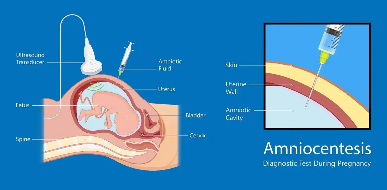 Illustrazione dell'amniocentesi: quando si fa, un ago preleva liquido amniotico dal feto guidato da ecografia.