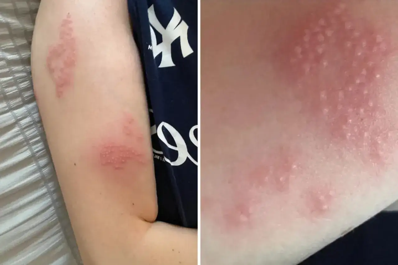 Close-up of a person's arm showing a rash of blisters, indicative of shingles. This image prompts the question: can you swim with shingles?