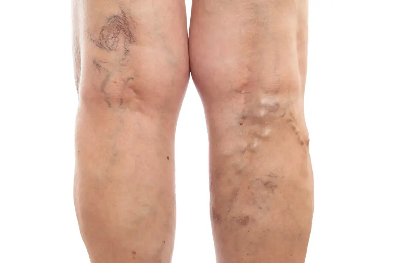 Piernas con venas varicosas y telangiectasias, indicativas de posible celulitis edematosa.