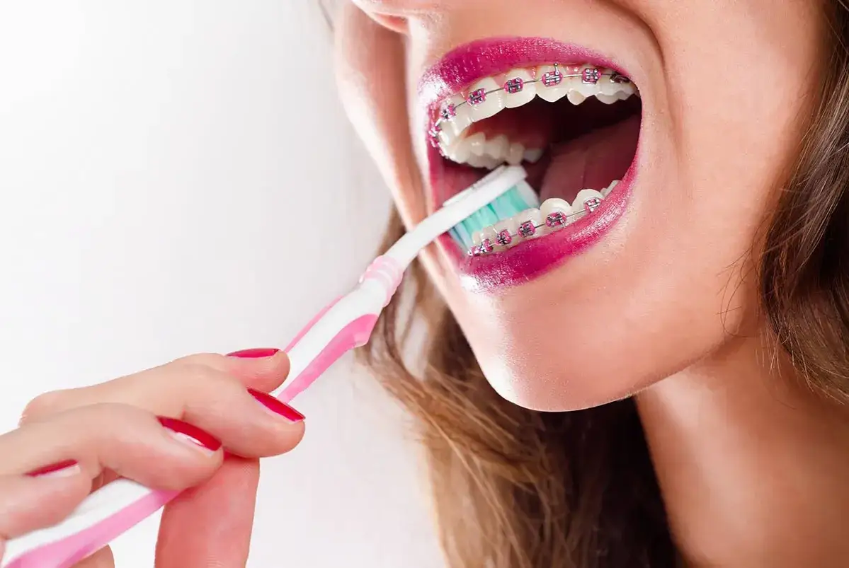 Mujer con brackets transparentes se cepilla los dientes con un cepillo rosa. Aprende como limpiar los brackets transparentes para una sonrisa radiante.