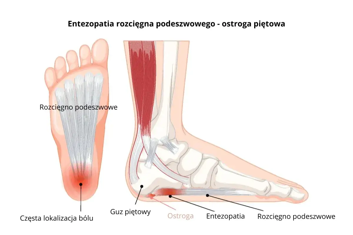 Anatomia stopy z zaznaczonym bólem pięty, ostrogą i entezopatią rozcięgna podeszwowego.