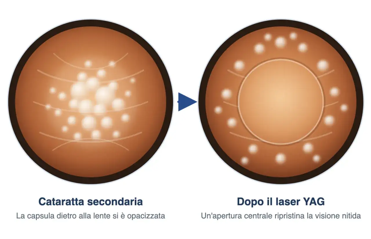 Capsulotomia YAG laser: prima opacit&agrave; capsulare, dopo apertura centrale per visione nitida. Convalescenza rapida.