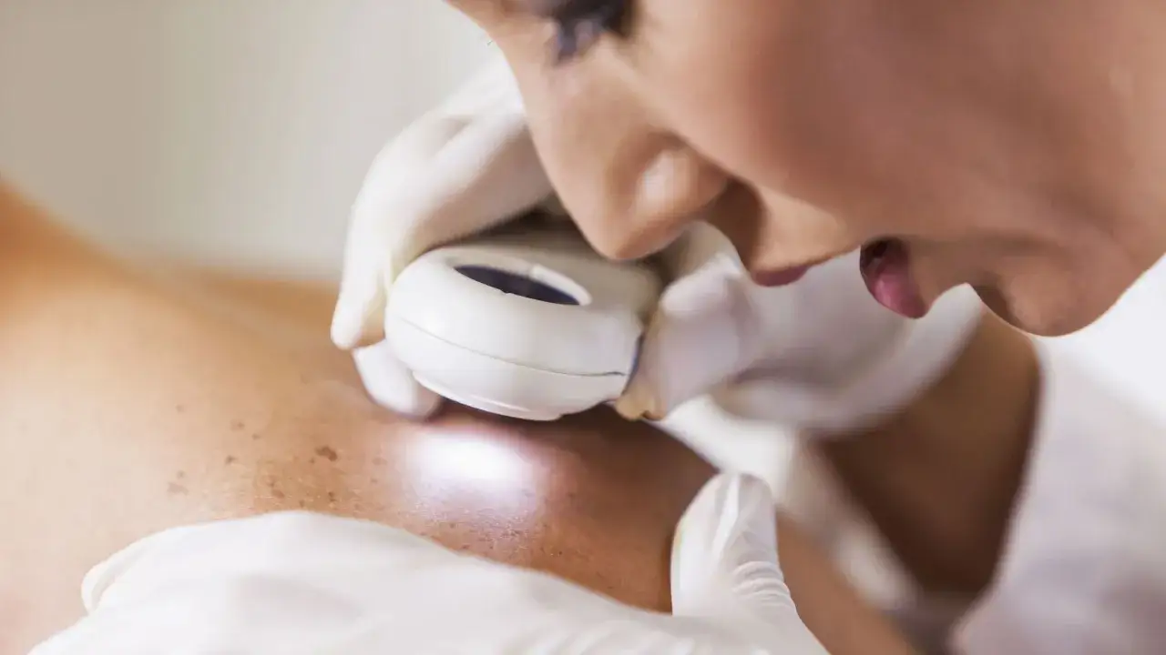 Dermatolog bada pieprzyki na skórze pacjenta za pomocą dermatoskopu. Może to być etap diagnostyki przed zastosowaniem kremów z hydrochinonem.