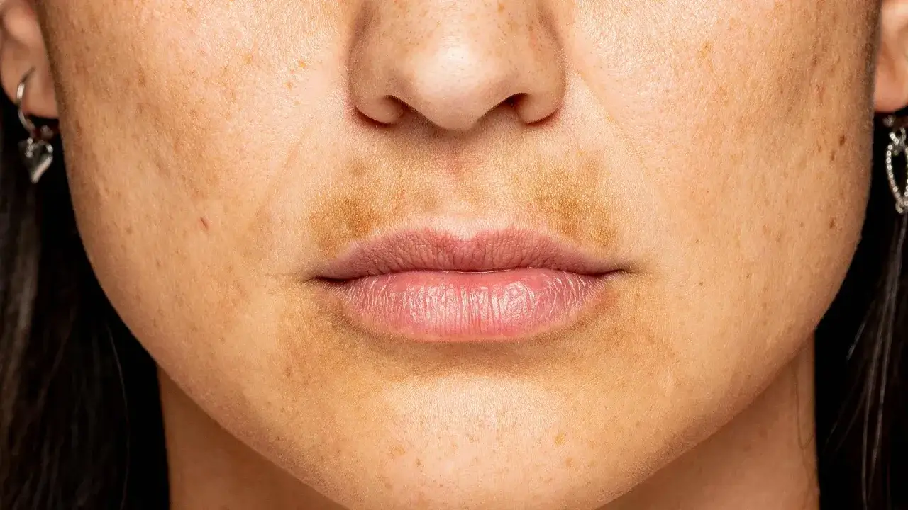 Primer plano de una mujer con melasma en el labio superior, simulando un bigote. La piel muestra pecas y algunas marcas.