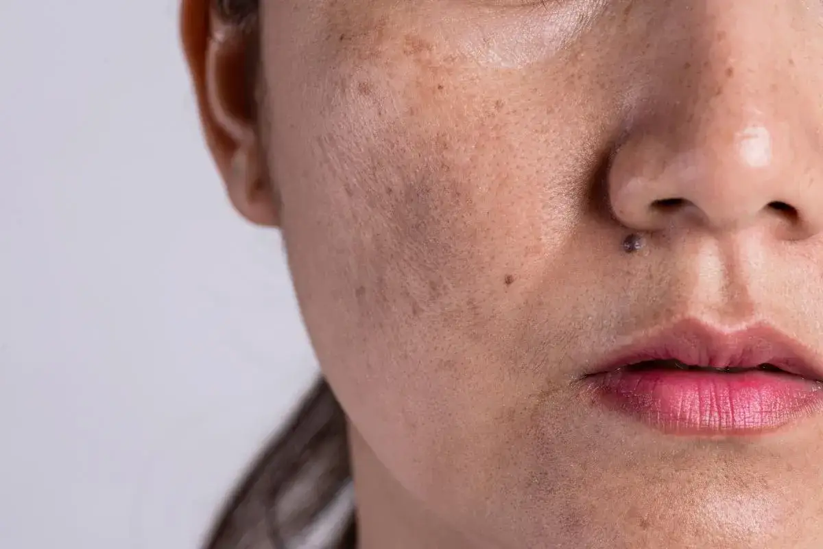 Primer plano de una cara con melasma y un pequeño lunar sobre el labio superior, simulando un bigote.