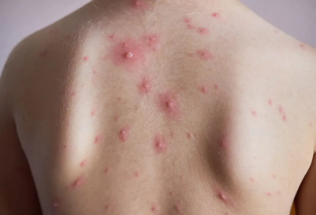Roter Ausschlag mit Bl&auml;schen auf dem R&uuml;cken eines Kindes, typisch f&uuml;r drei Tage Fieber Ausschlag.