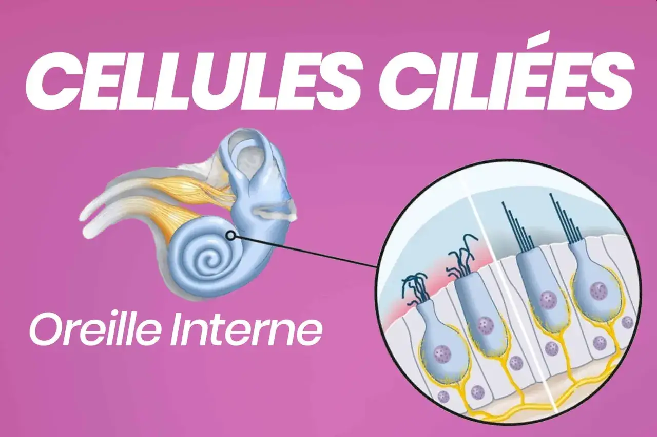 Illustration de l'oreille interne montrant des cellules ciliées endommagées, avec un zoom sur les cils abîmés.