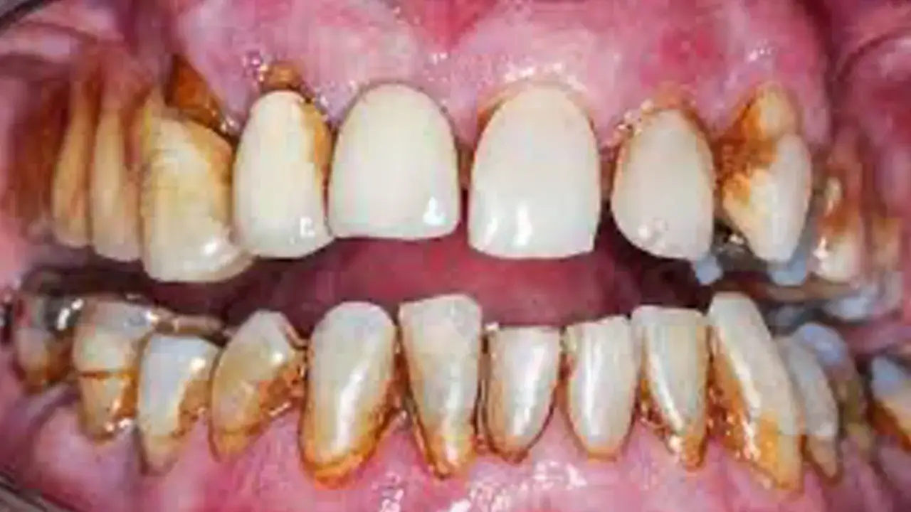 Denti con tartaro esteso e gengive infiammate, segni evidenti di parodontite grave.