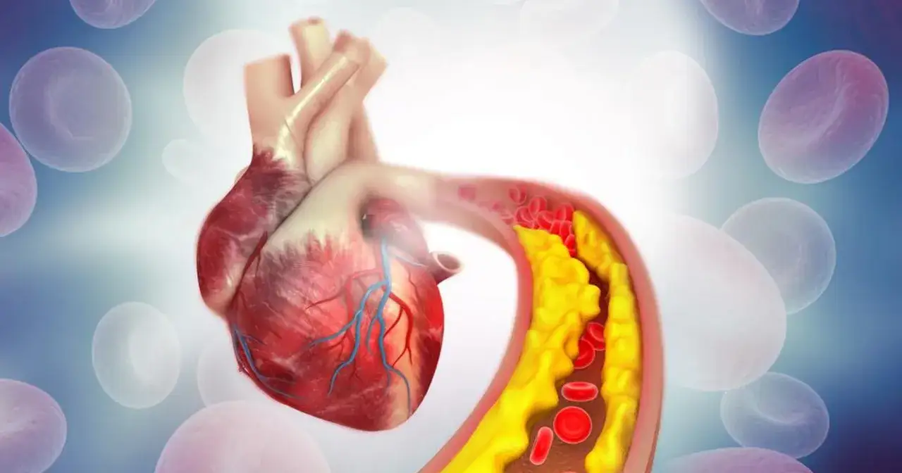 Serce i tętnica z cholesterolem. Wysoki cholesterol nie HDL może prowadzić do chorób serca.