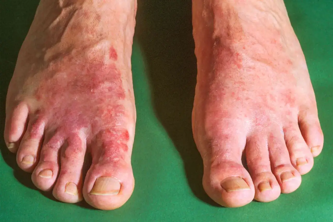 Pieds rouges et irrités, avec des boutons sur les pieds qui grattent, particulièrement sur le dessus et entre les orteils.