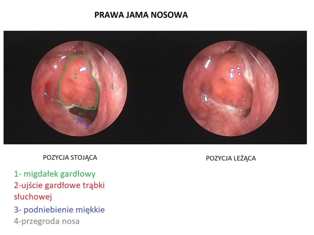 Obraz przedstawia prawą jamę nosową. Widoczny jest migdałek gardłowy (trzeci migdał) w pozycji stojącej i leżącej, wraz z ujściem trąbki słuchowej, podniebieniem miękkim i przegrodą nosa.