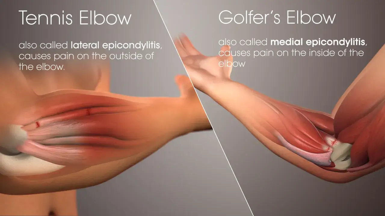 Vergleich von Tennisarm und Golferarm: Anatomische Darstellung der Sehnenansätze am Ellenbogen, die bei Golferarm-Symptomen entzündet sind.