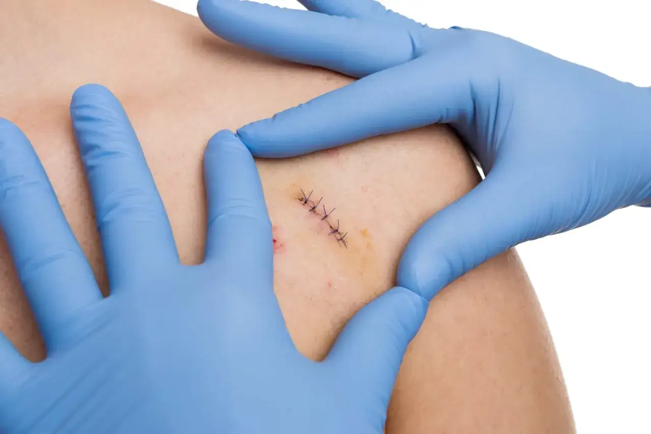 Mains gantées examinant une plaie suturée. Le point de suture est visible, pas encore de pansement.