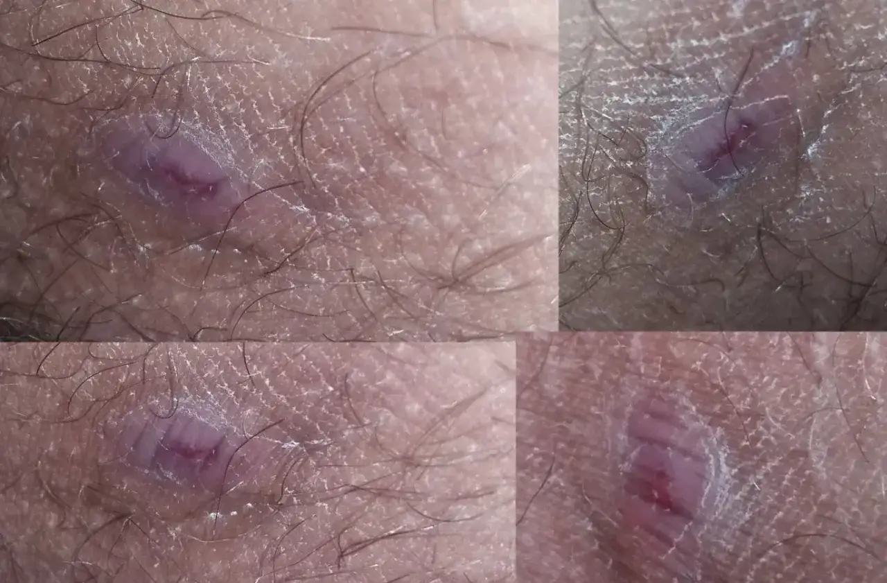 Zbliżenie na skórę z widocznym, zaczerwienionym czyrakiem w pachwinie, otoczonym włoskami.