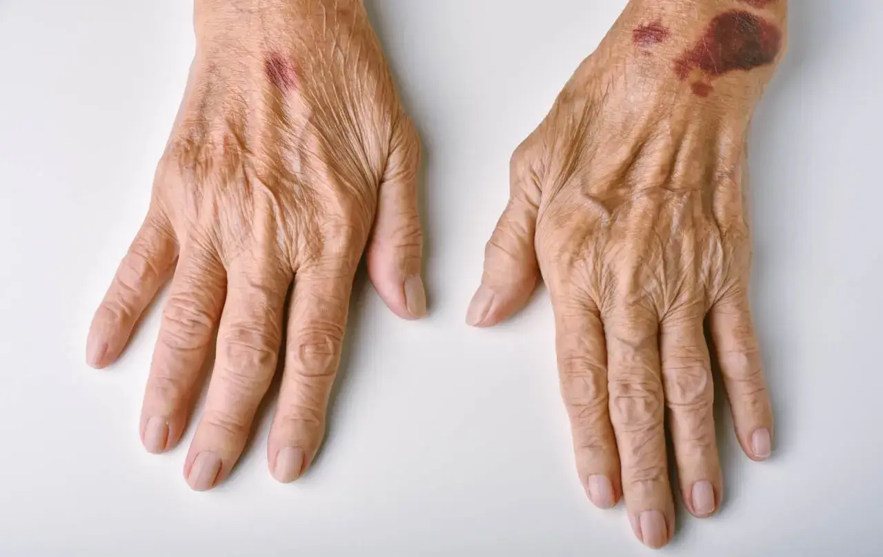 Mani anziane con pelle rugosa e macchie di sangue, segni del tempo e fragilità.