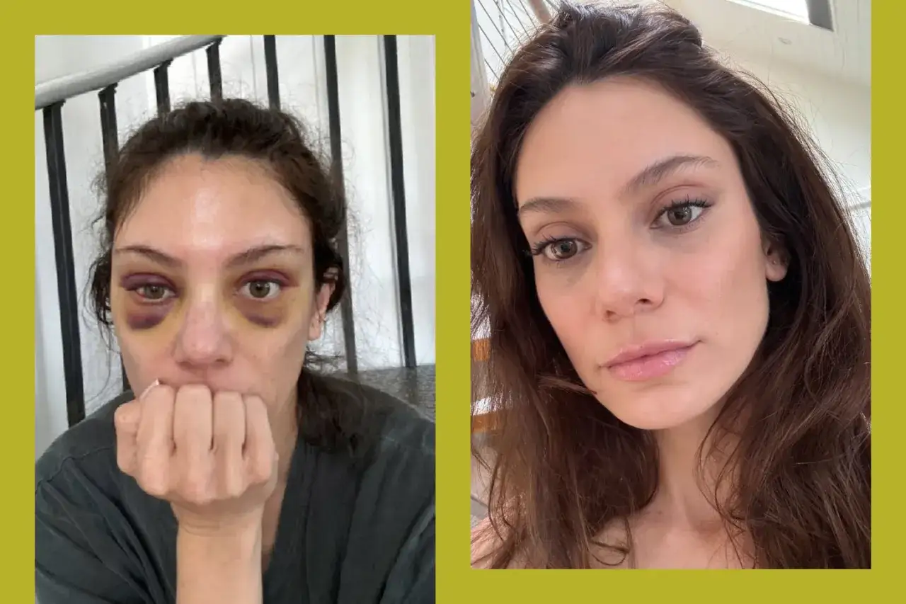Avant/après : ecchymoses sous les yeux après un rehaussement sourcils. La deuxième image montre un visage sans ecchymoses.