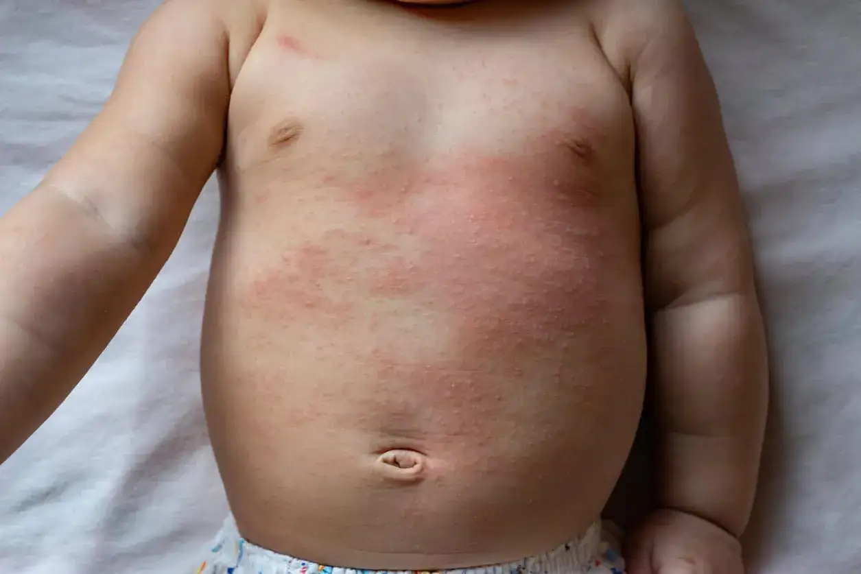 Piel enrojecida y con pequeños bultos en el pecho de un bebé, indicativo de dermatitis por calor o sudor.