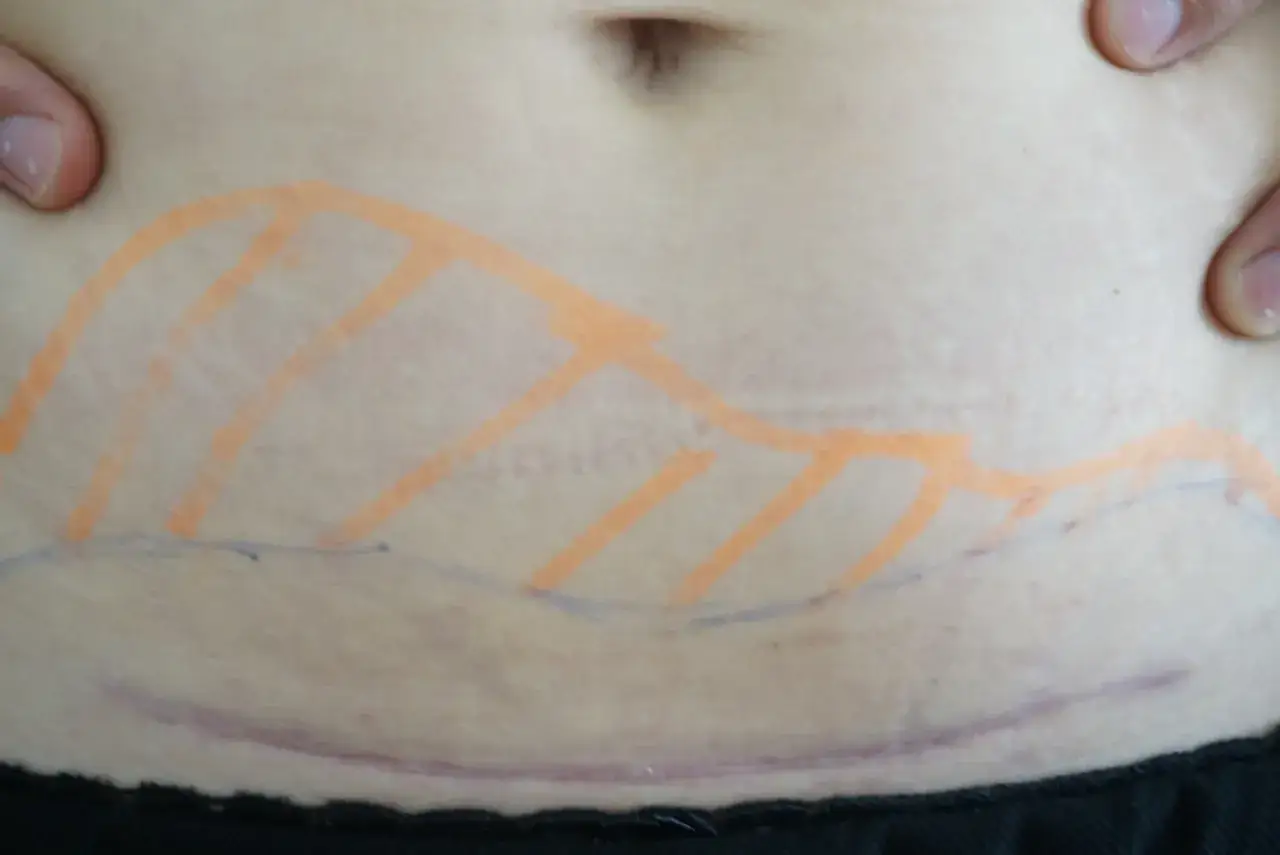 Hud med &auml;rr efter kejsarsnitt, markerad med orange och bl&aring; linjer.