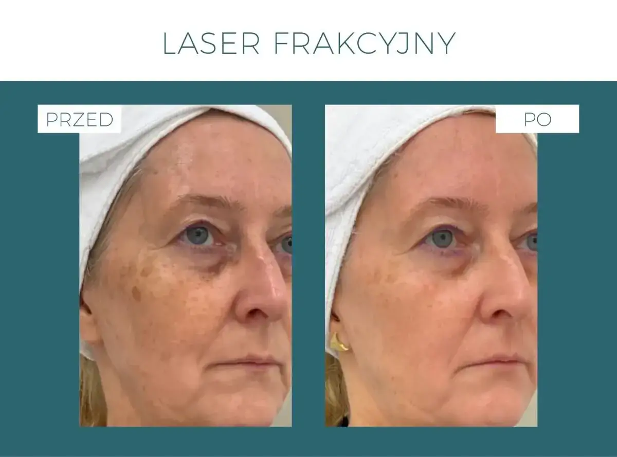 Laser frakcyjny przed i po: widoczna redukcja przebarwień i poprawa tekstury skóry.