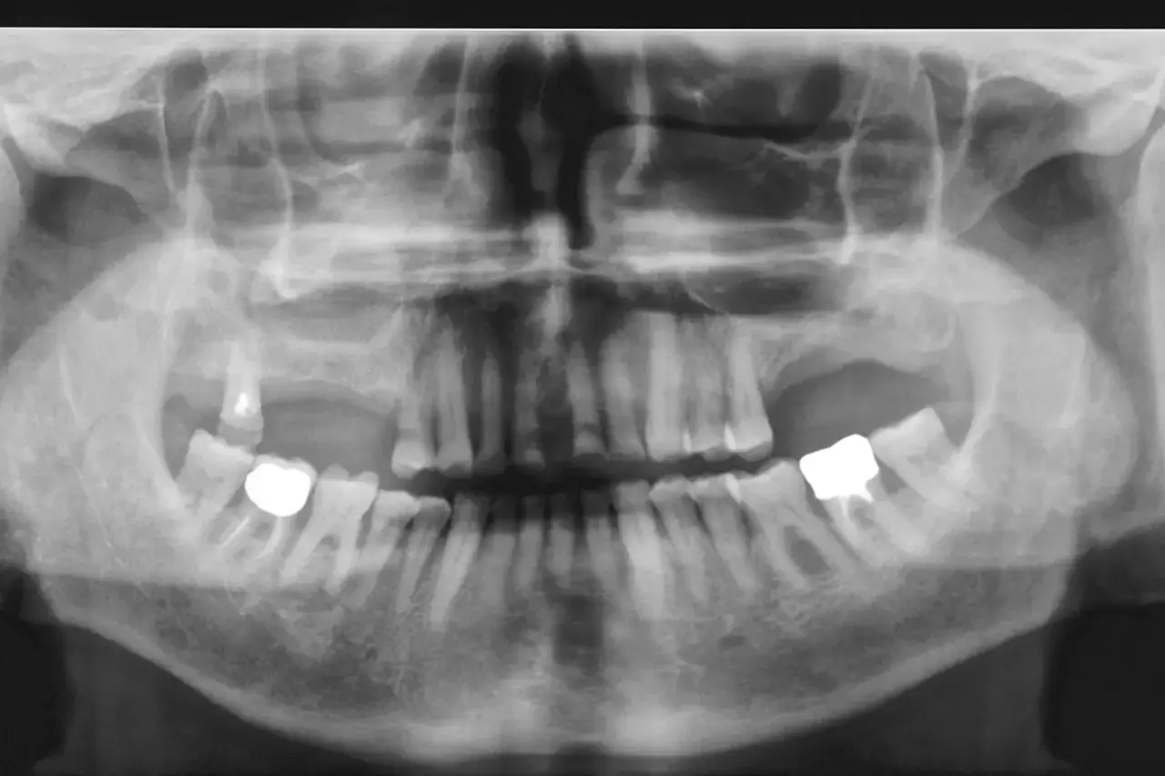 Radiografia panoramica dentale che mostra segni di sinusopatia mascellare, con opacità nei seni mascellari e alterazioni dentali.