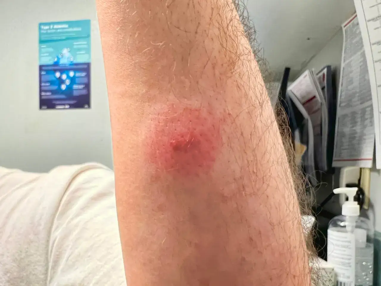 Zdjęcie Symptome Borreliose beim Menschen: Warnzeichen, die Sie kennen sollten