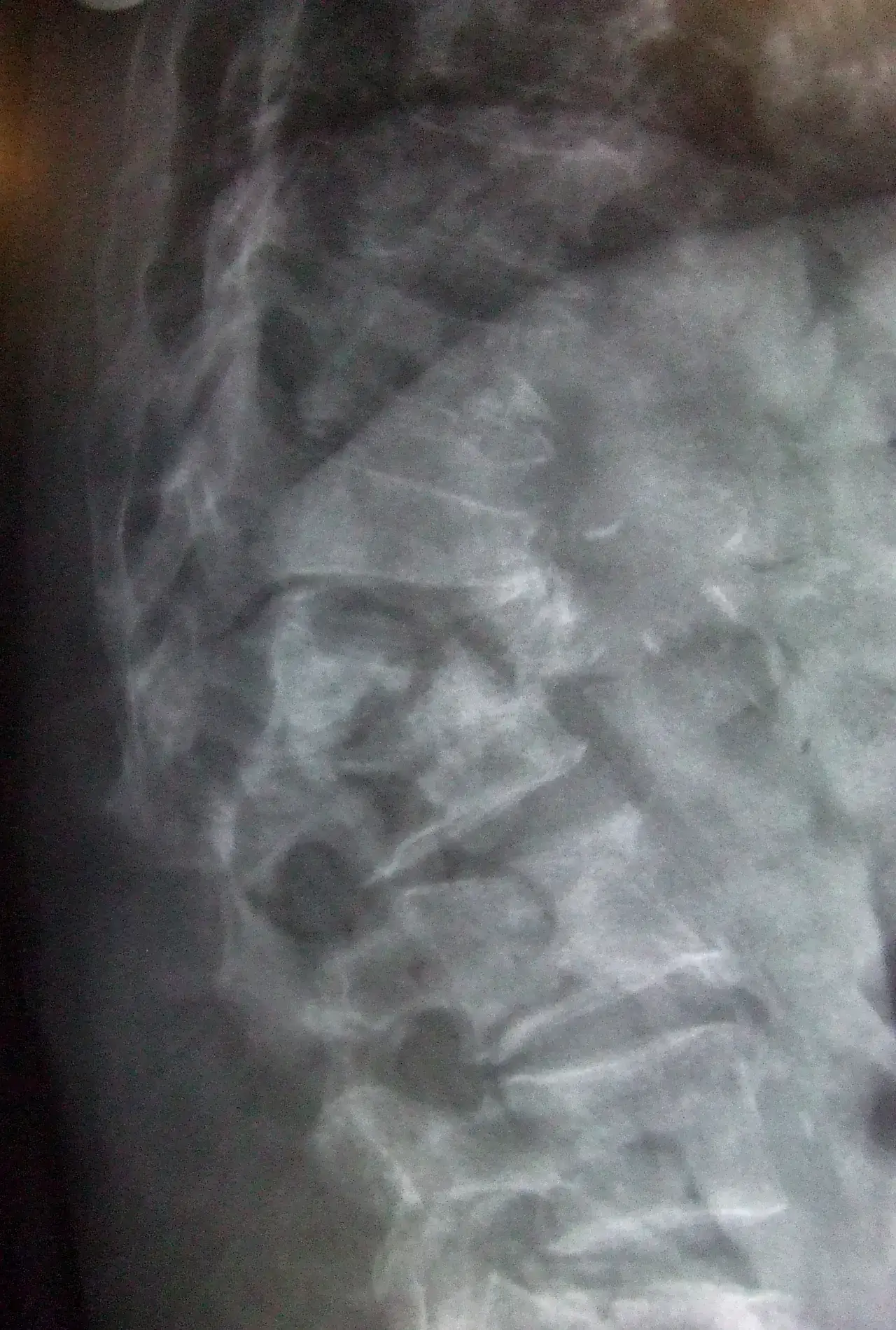 Zdjęcie Quién descubrió la osteoporosis y su impacto en la salud ósea