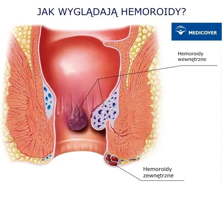 Zdjęcie Do jakiego lekarza z hemoroidami: poznaj najlepszego specjalistę w 2025