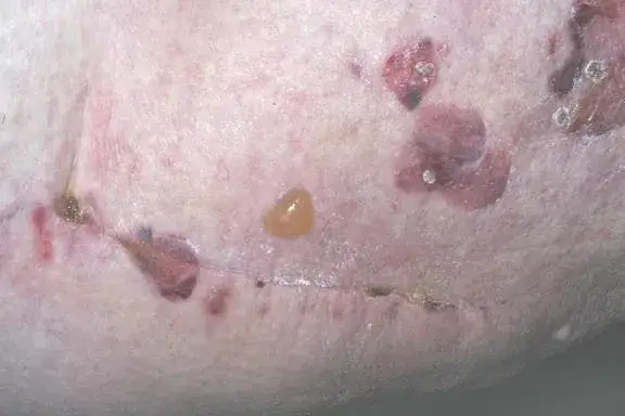 Zdjęcie Morbus Duhring Diagnostik: Wichtige Tests und Verfahren zur sicheren Diagnose