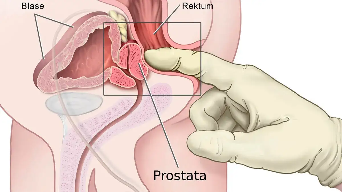 Zdjęcie Wichtige Informationen zur Vorsorge Prostatakrebs: Tests und Empfehlungen