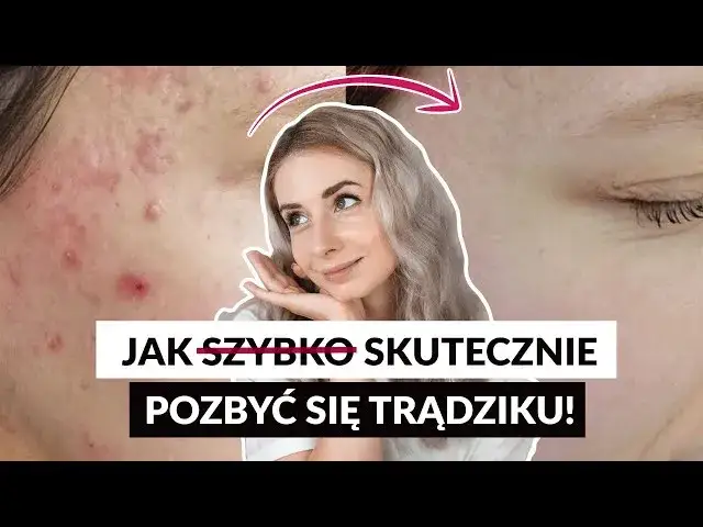 Zdjęcie Jak pozbyć się pryszczy w kilka godzin - sprawdzone metody na szybko