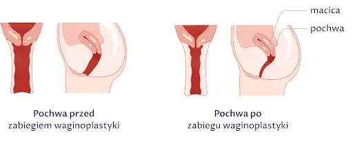 Zdjęcie Jak długo L4 po plastyce pochwy? Poznaj czas rekonwalescencji