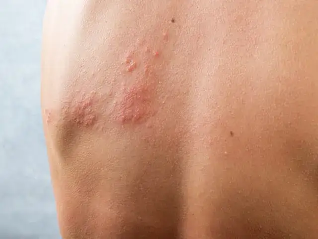 Zdjęcie Czy sezam uczula? Objawy alergii i jak ich unikać