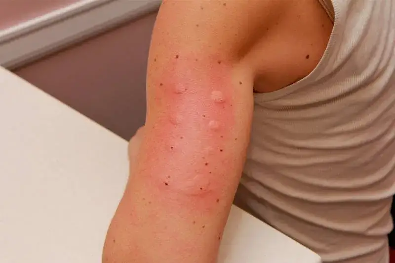 Zdjęcie Uczulenie na perfumy: jak rozpoznać objawy i uniknąć reakcji alergicznych
