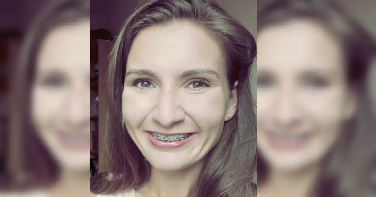 Zdjęcie Jak długo trzeba nosić aparat na zęby? Czas leczenia i ważne informacje