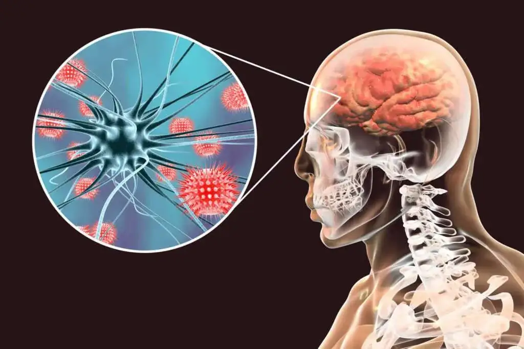 Zdjęcie Hirnhautentzündung Diagnostik: So erkennen Sie die Symptome rechtzeitig