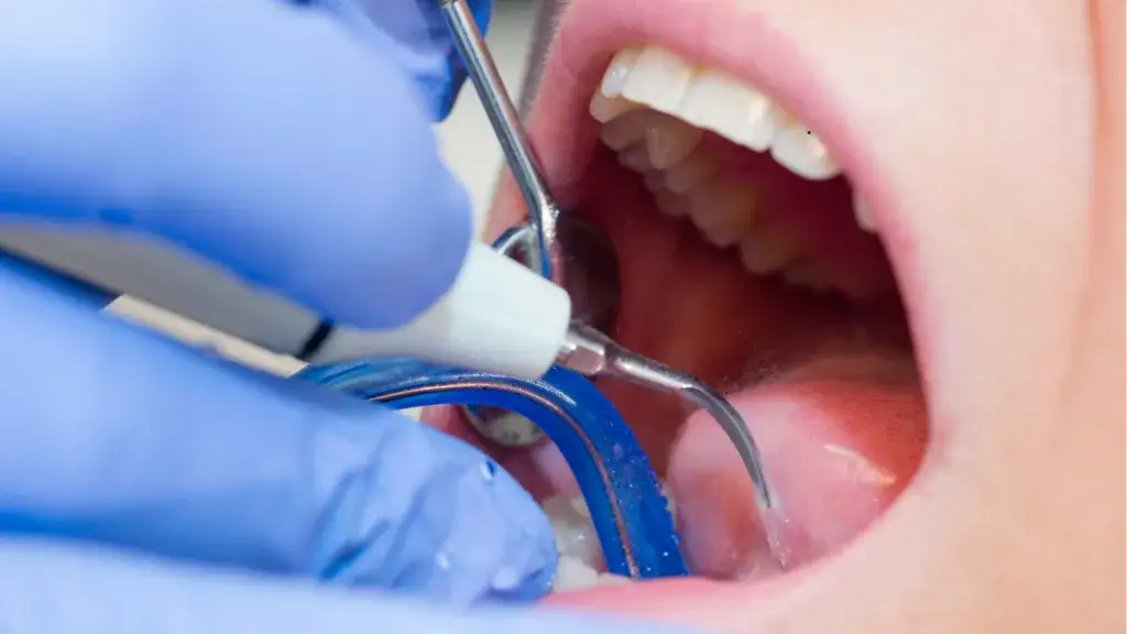 Zdjęcie Jak dentysta usuwa kamień nazębny bez bólu i skutecznie?