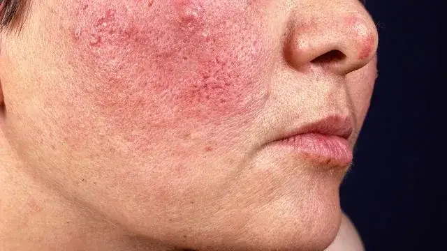 Zdjęcie Ursachen für brennende Gesichtshaut: Symptome und wirksame Lösungen
