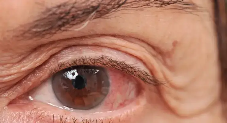 Zdjęcie Síntomas de glaucoma: cómo reconocer señales de alerta y evitar la ceguera